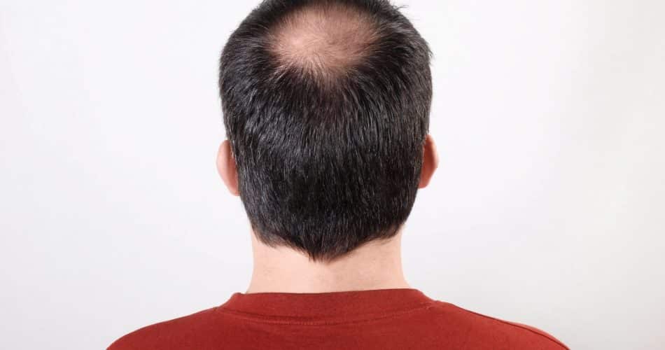 back of male head with thinning hair or alopecia or hair loss