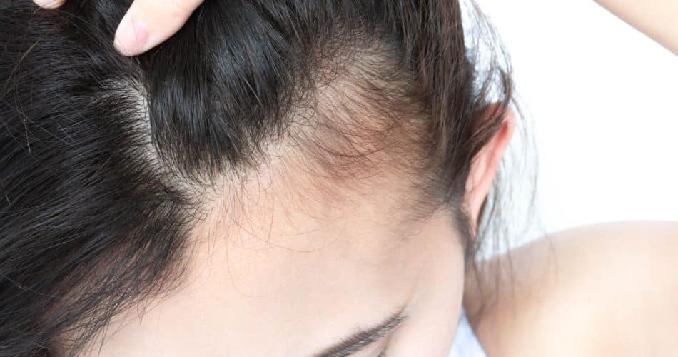 Woman serious hair loss problem for health care shampoo and beauty product concept
